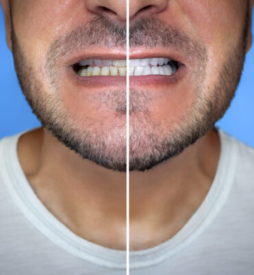 A man before and after teeth whitening on colored background, close-up.