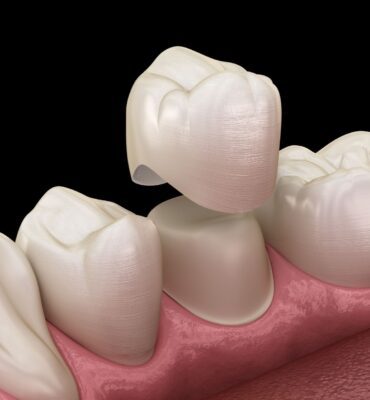 dental-crowns-88