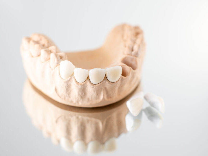 Close-up on plaster model of artificial jaw with veneers on the mirror background. Concept of aesthetic dentistry and design of veneers