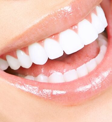 hollywood-smile-44