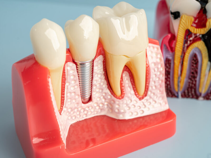 Dental implant, artificial tooth roots into jaw, root canal of dental treatment, gum disease, teeth model for dentist studying about dentistry.