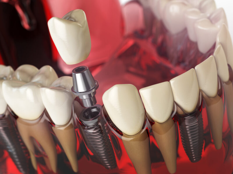 All On 6 Treatment