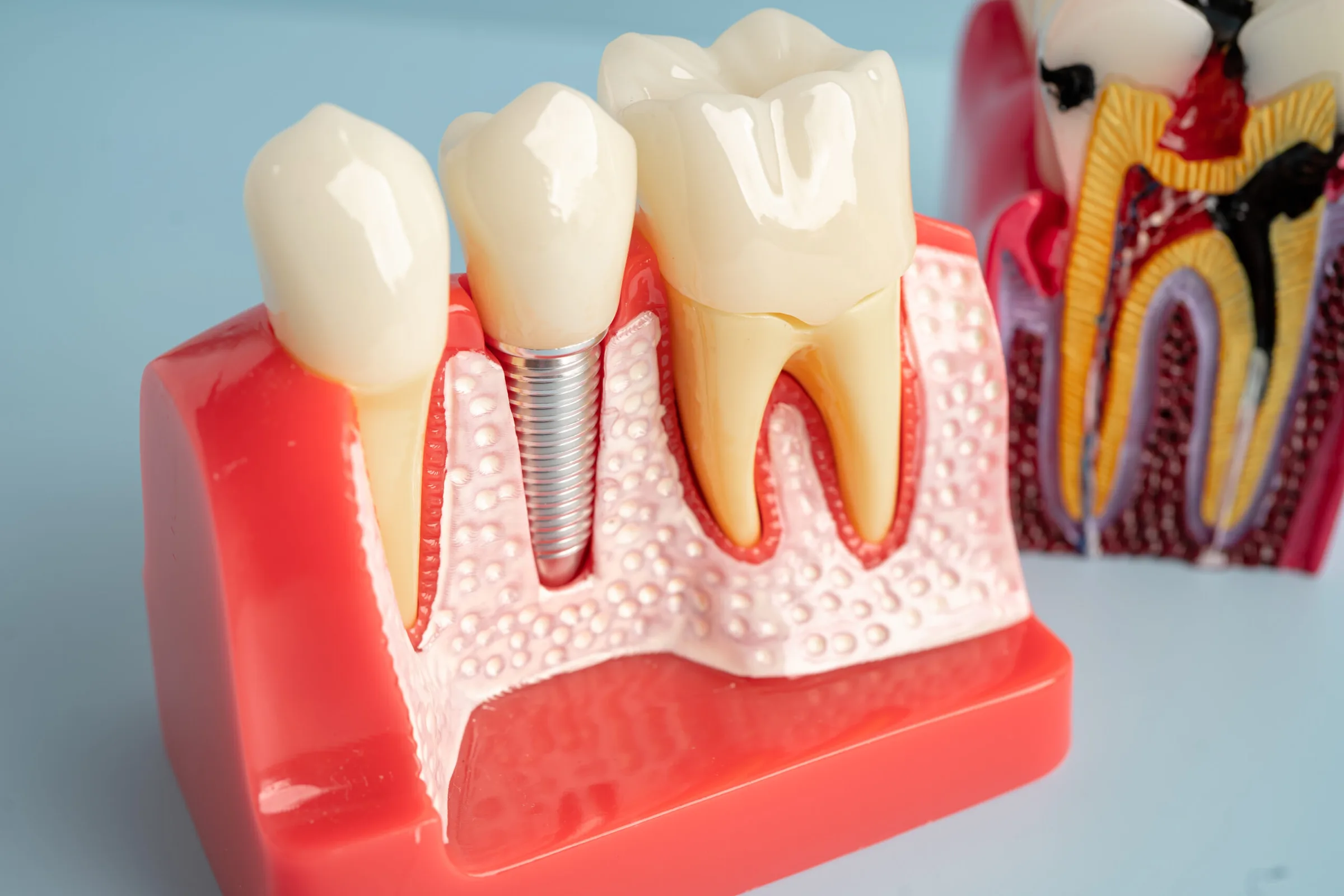 Diş implantını gösteren eğitim amaçlı çene modeli (temsili fotoğraf)