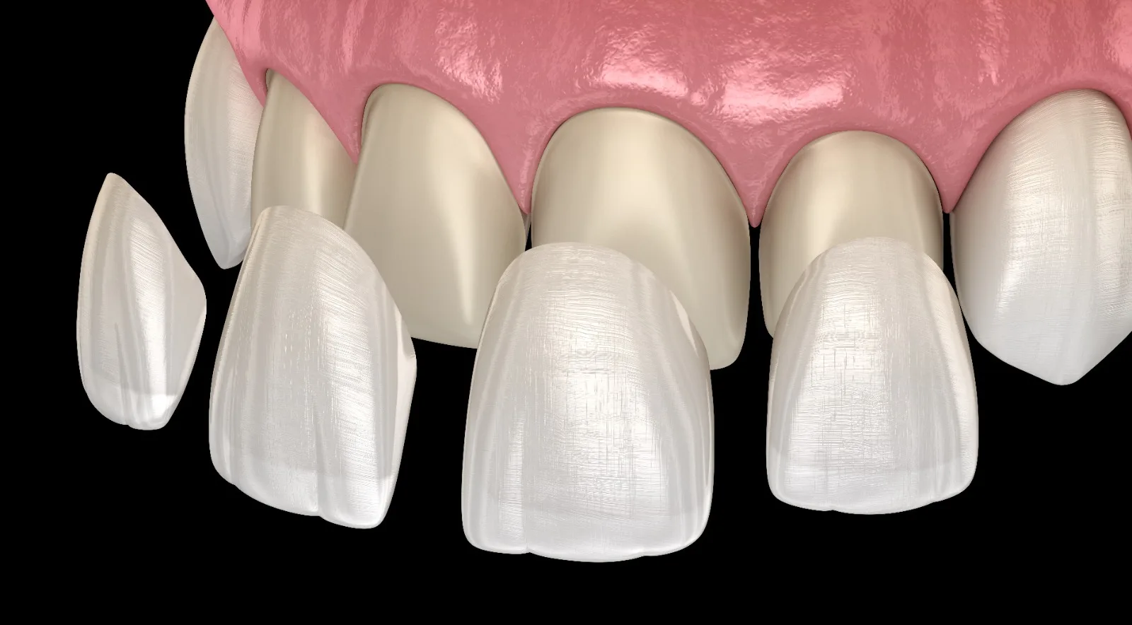 Illustration 3D de facettes en céramique posées sur les dents de devant