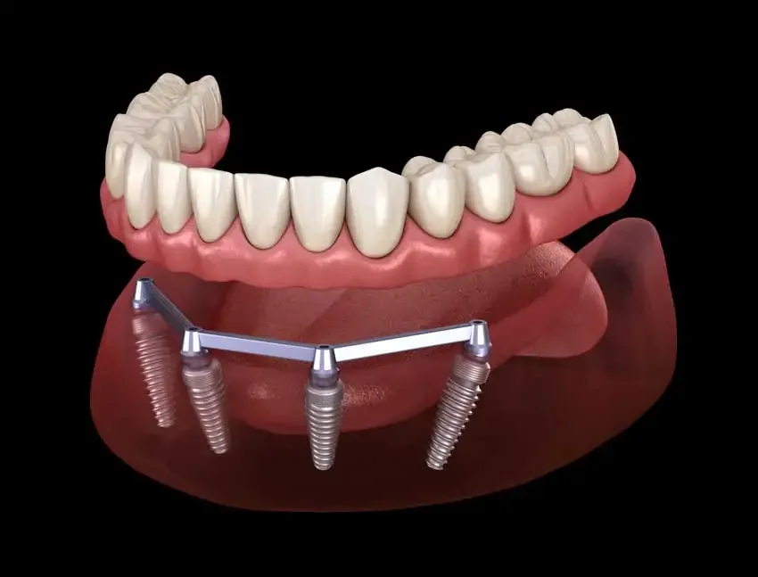 Illustration 3D d'une prothèse complète fixée sur quatre implants dans la mâchoire inférieure