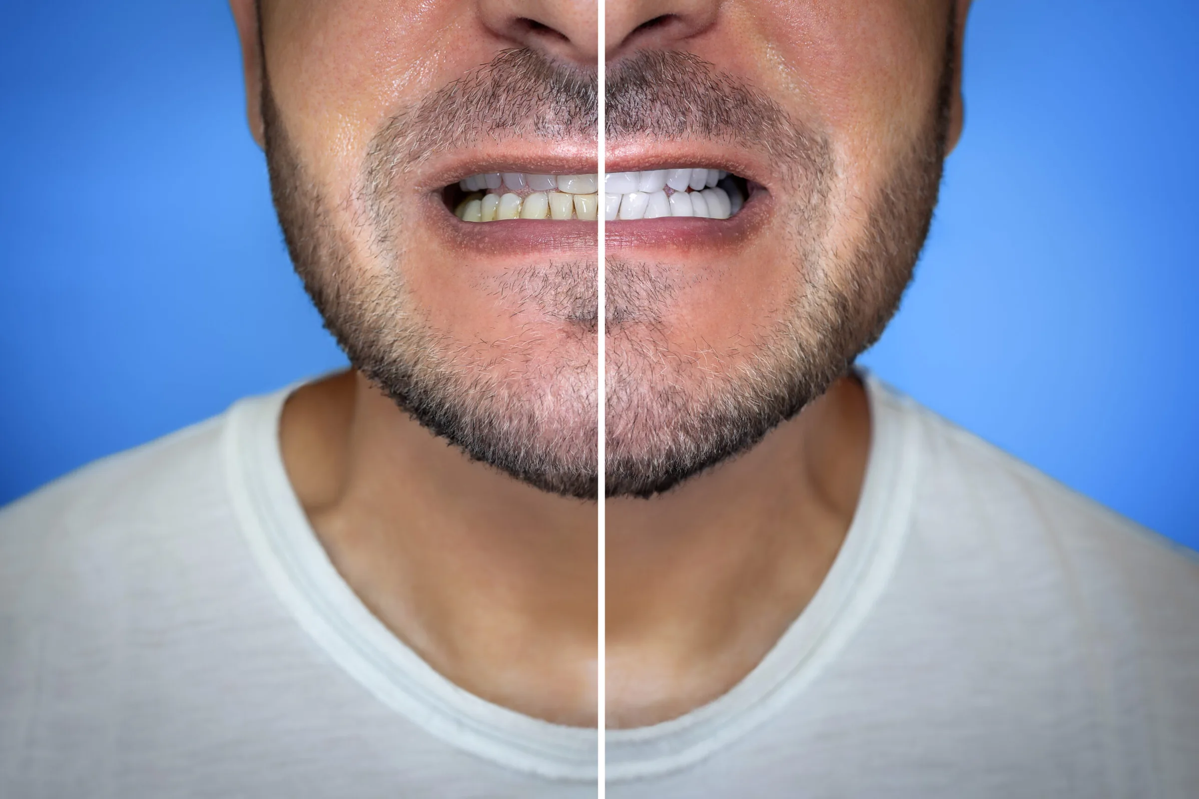 Montage avant/après d'un sourire masculin (image d'illustration, pas un patient de la clinique)